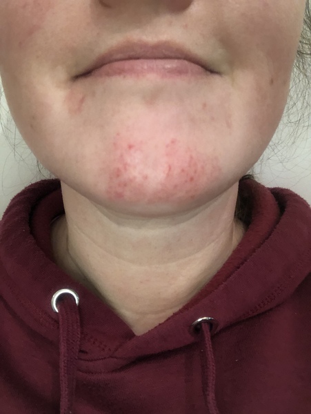 Anyone have an idea how to rid myself of these spots?