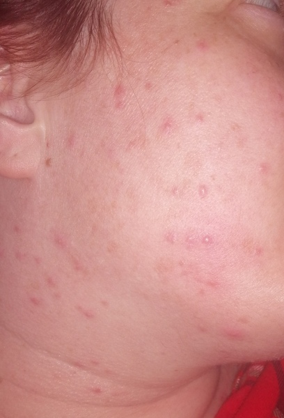 To think this is adult acne?!