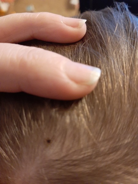Mark on skin growing