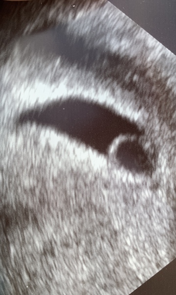 Large yolk sac