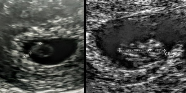 Early scans - 6 weeks versus 8 weeks
