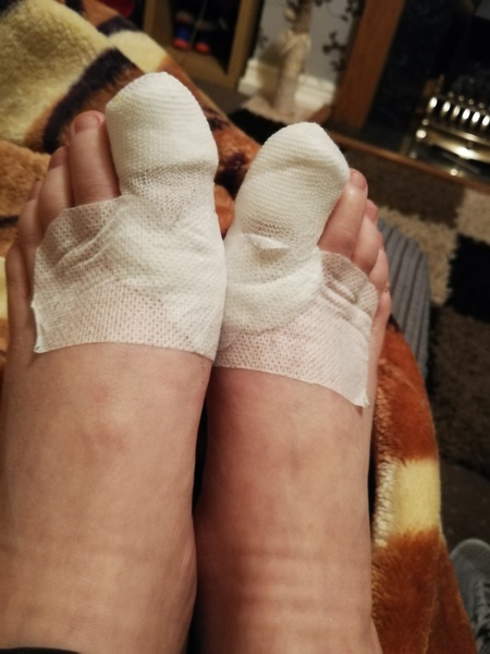 Nail surgery - warning foot picture included
