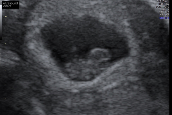 Scans at 8 weeks and 4 days