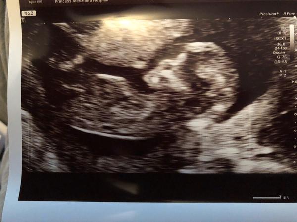 Skull/Nub Theory opinions? boy or girl? xx