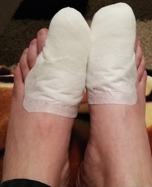 Nail surgery - warning foot picture included