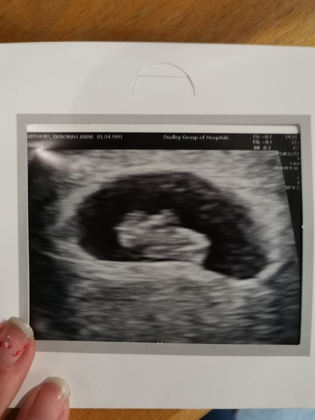 8 week scan nerves-so ridiculous