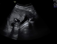 Wrong early gender scan?