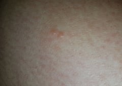 Help .....What the hell is biting me?