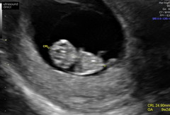 What did your early scan look like?