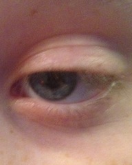 DS eye has swollen!