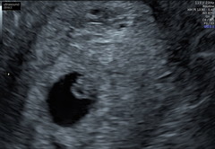 Large yolk sac