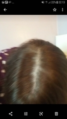 Thinning hair advice?