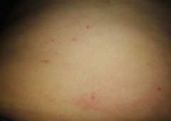 What’s this rash please?!