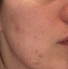 Help me sort my skin out...please