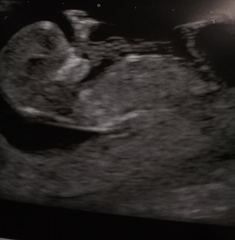Boy or Girl guesses from Skull/Nub theory