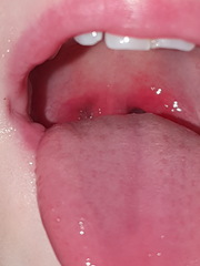 Tonsils still look inflamed?