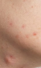 Adult spots, why won't they go