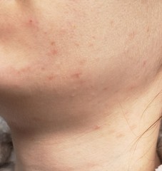 Adult spots, why won't they go