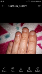 Nail biting