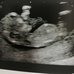 Boy or Girl guesses from Skull/Nub theory
