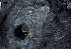 Large yolk sac