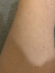 Itchy rash at 21 weeks