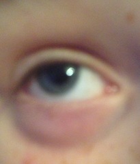 DS eye has swollen!