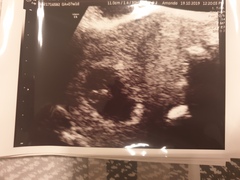 TTC after miscarriage - February 2020