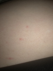 What’s this rash please?!