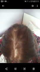 Thinning hair advice?