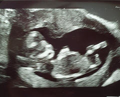 What did your early scan look like?