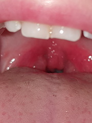 Tonsils still look inflamed?