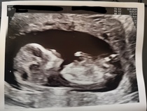Boy or Girl? Nub and skull.