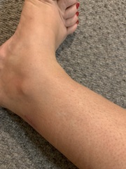Itchy rash at 21 weeks