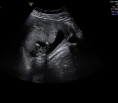 Wrong early gender scan?
