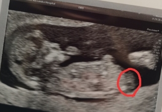 12 week scan do you think girl or boy?