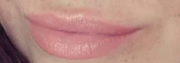 Lip fillers!