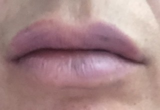 Lip fillers!