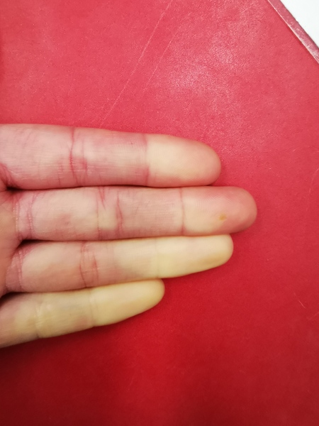 Raynauds - aibu to see GP? Any point?