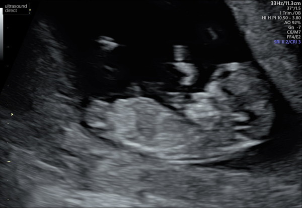 BFP! August/September 2020 Babies!