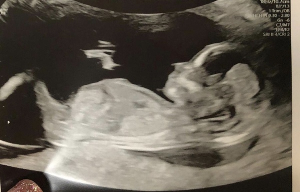 Boy or girl? 13 week scan (just for fun!)