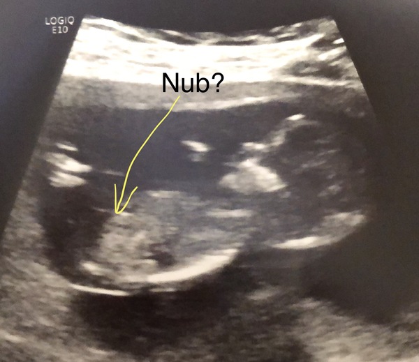 Is this the “nub”?