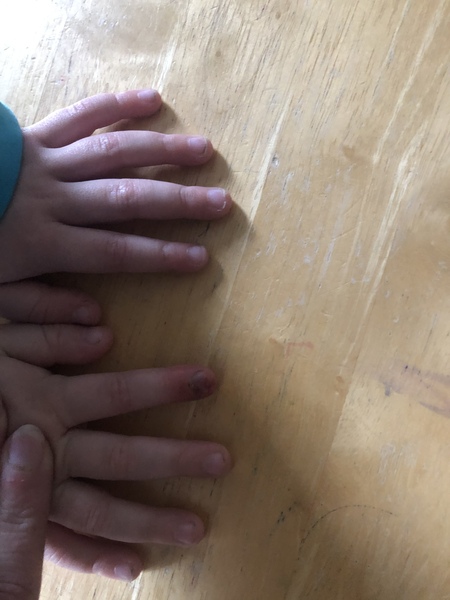 Does this need to be looked at (trapped finger)