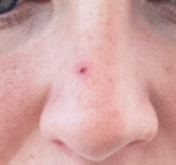 Basal Cell carcinoma - nose