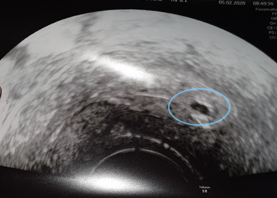 Referred for early scan - red blood last night - need a hand hold