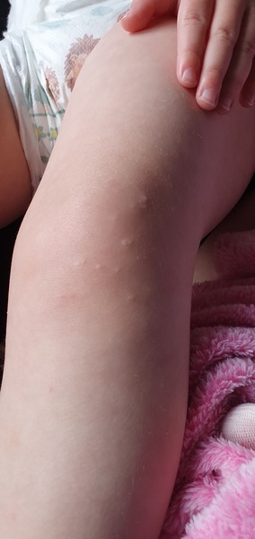 Bumps on toddlers knee