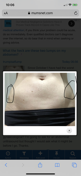 What the heck are these two lumps on my abdomen?