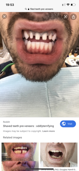 Veneers