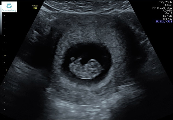 Pregnant after loss and dreaming of rainbows....