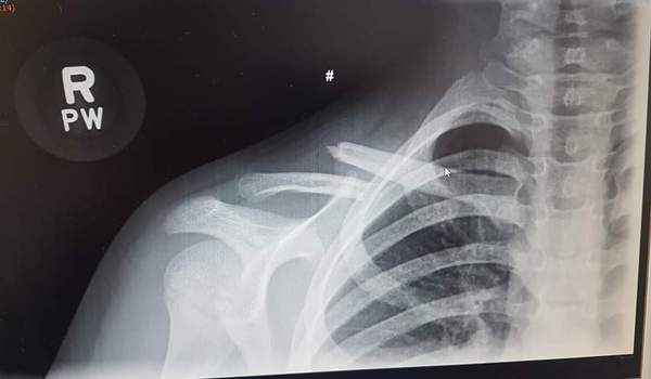 6yr old broken collar bone
